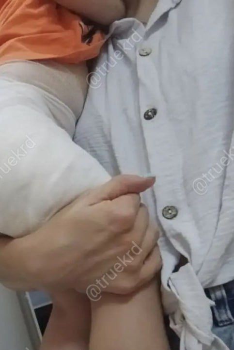 Полуторагодовалая девочка получила химический ожог в детском саду в Сочи