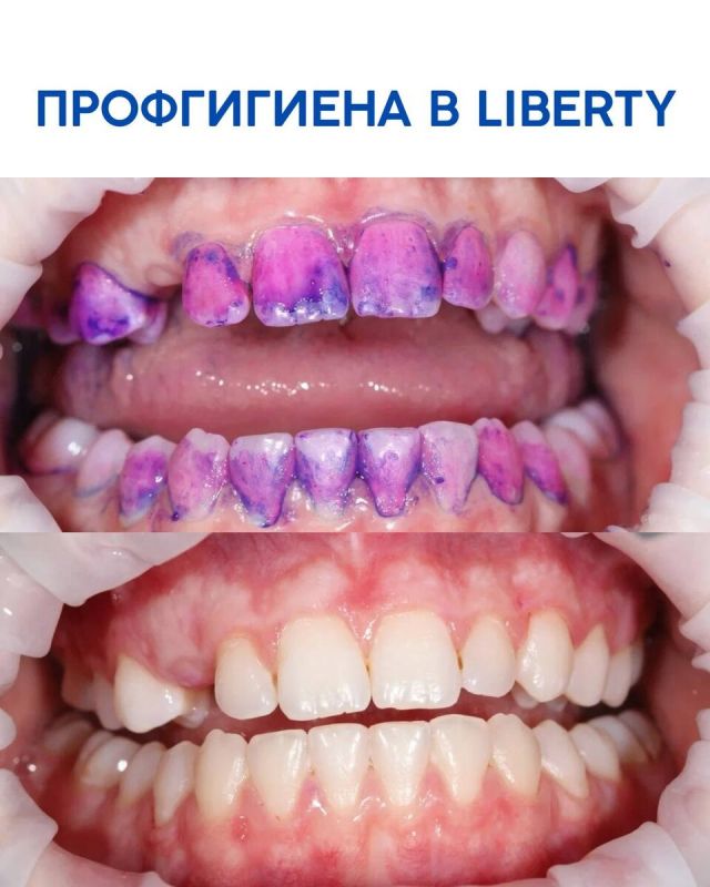 Забота о здоровье зубов в стоматологии Liberty